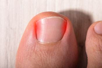 Ingrown toenail specialist in the Suffolk County, NY: Smithtown, Brentwood, Central Islip, Hauppauge, Lake Grove, Kings Park, Сommack, Ronkonkoma, Holbrook, Holtsville, Farmingville, Selden NY areas